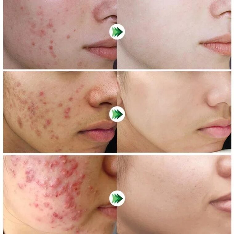 Stop Acne Before It Starts: The Power of Tea Tree & Salicylic Acid for Pakistani Skin