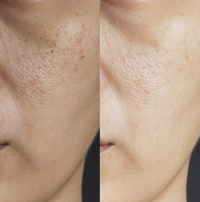 The Science of Hydration: Why Hyaluronic Acid is Essential for Pakistani Skin